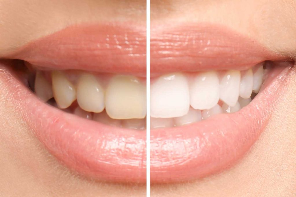 Unterschied zwischen den Zahnfarben vor und nach dem Bleaching - gezeigt am Lächeln vor und nach der Behandlung.