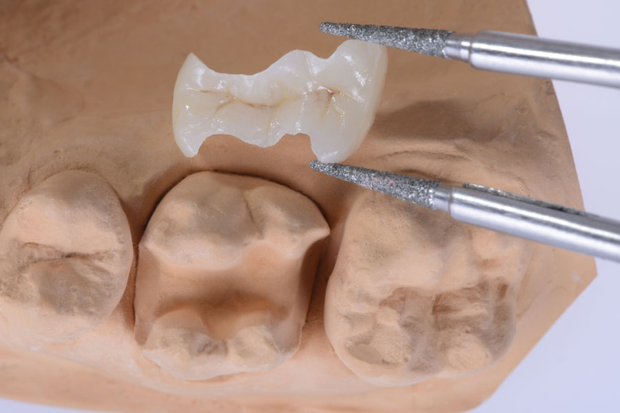 Vollkeramisches Inlay, wird vom Abdruck gefertigt, passgenau modelliert und an Ihre Zahnfarbe angepasst - Mittels Füllungstherapie kann ein Zahnhartsubstanzdefekt ausgeglichen werden